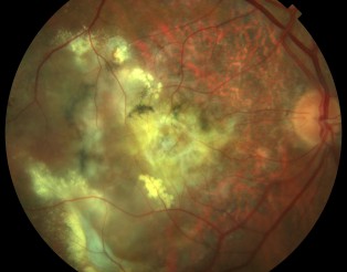 7832_DMAE exudativa color