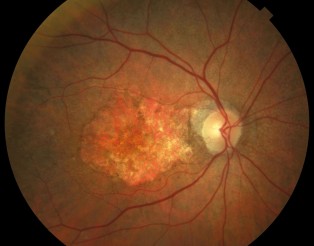 DMAE atrofica 2 (RGB)