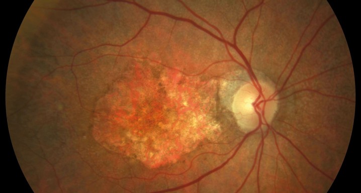 DMAE atrofica 2 (RGB)