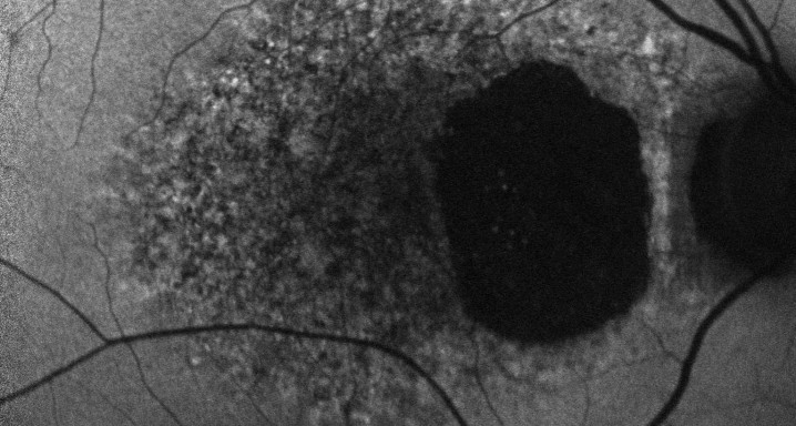 Distrofia coroidea areolar central