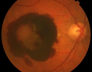 Hemo intraocular i subretiniana