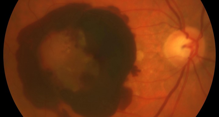 Hemo intraocular i subretiniana