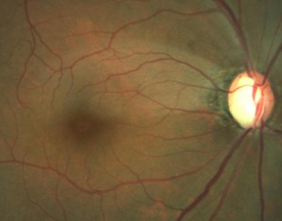 Nervi óptic glaucomatos