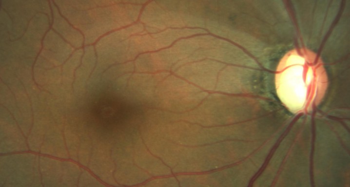 Nervi óptic glaucomatos