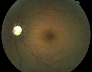 Nervi óptic glaucomatos molt avançat