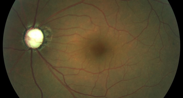 Nervi óptic glaucomatos molt avançat