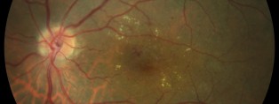 RD edema macular