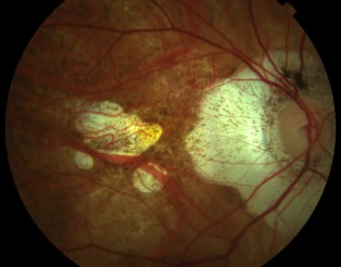 Retinografia miopia patologica