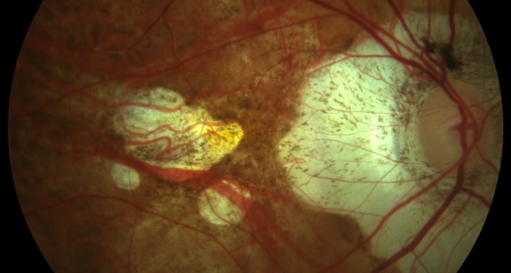 Retinografia miopia patologica