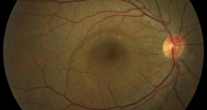 Retinografia serosa central