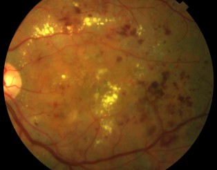 Retinopatia diabetica