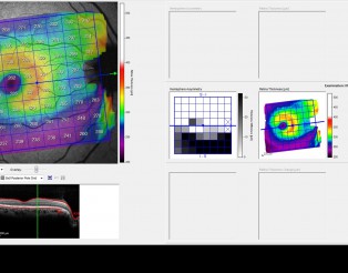 Tractament mèdic glaucoma