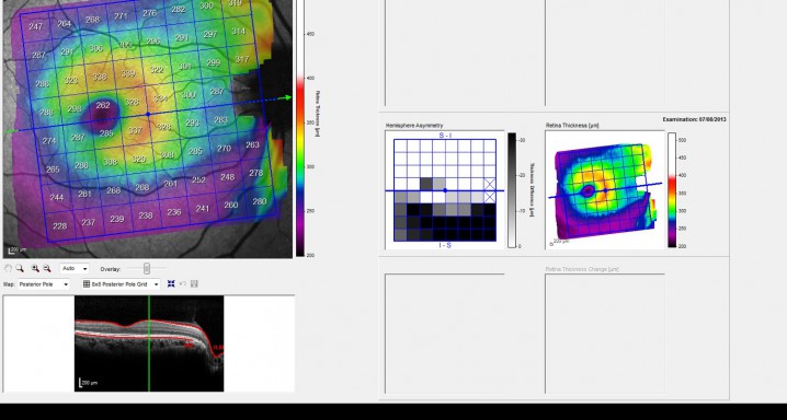 Tractament mèdic glaucoma