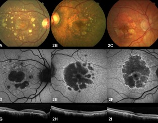 bjophthalmol-2017-310268-F2.large