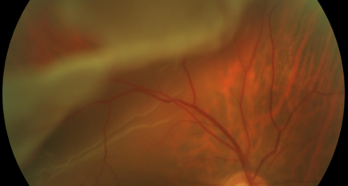 desprendimiento-de-retina