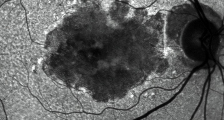 entrev autofluo DMAE atrofica (RGB)