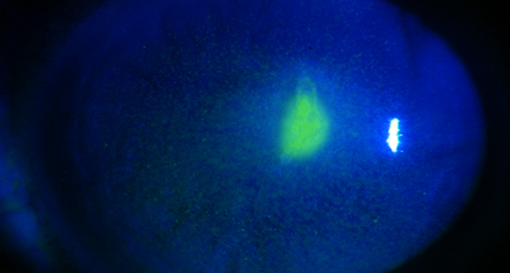 erosion-corneal-recividante