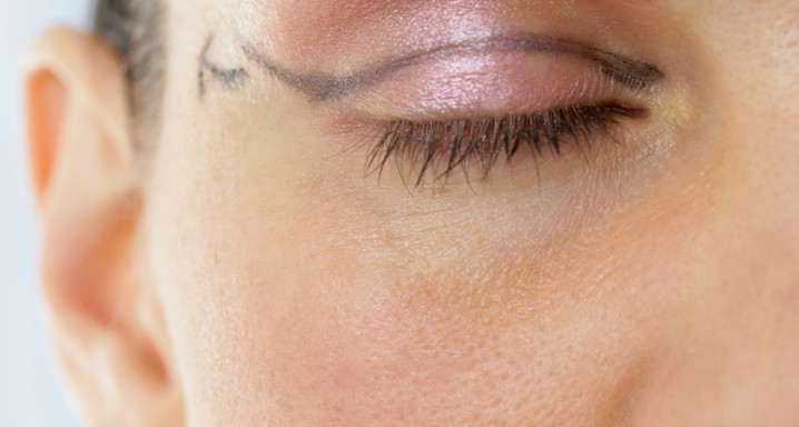 Chirurgie esthétique - Paupières