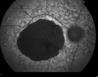 stargardt 5 autofluo