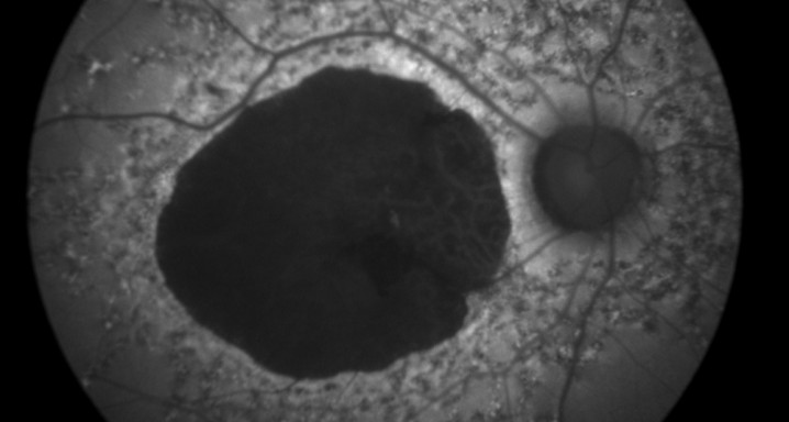 stargardt 5 autofluo